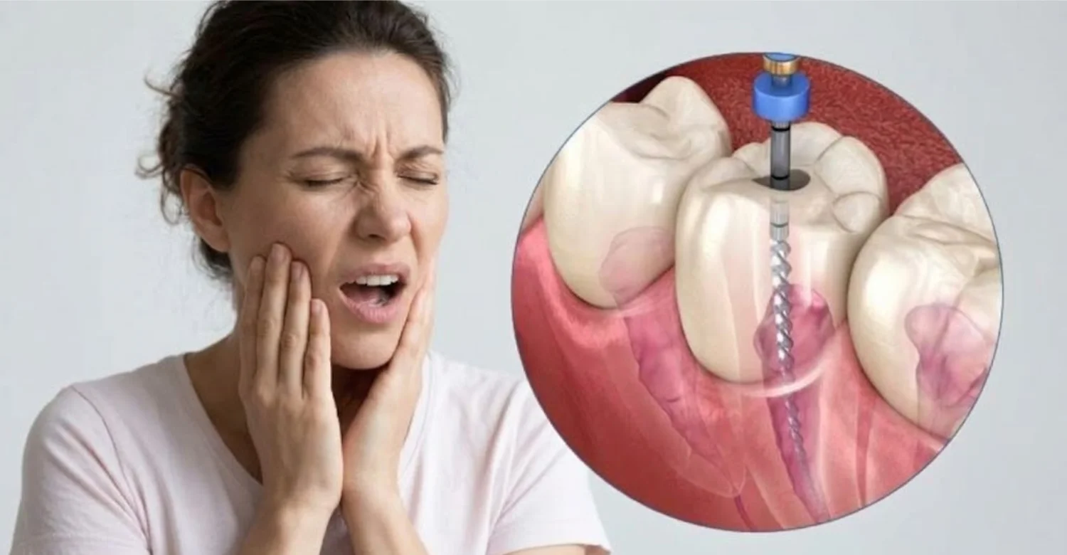 pain after root canal treatment1